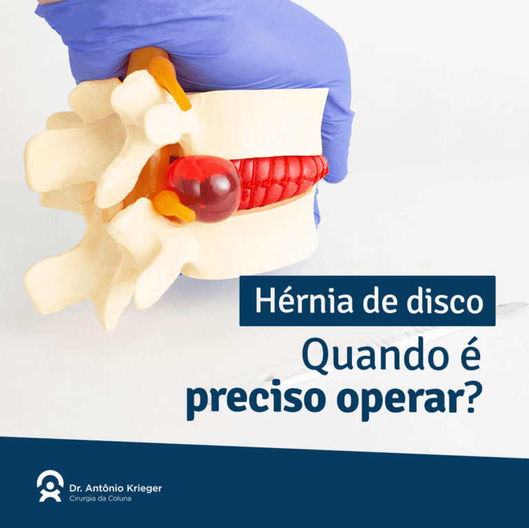 Hérnia de disco quando é preciso operar Dr Antônio Krieger