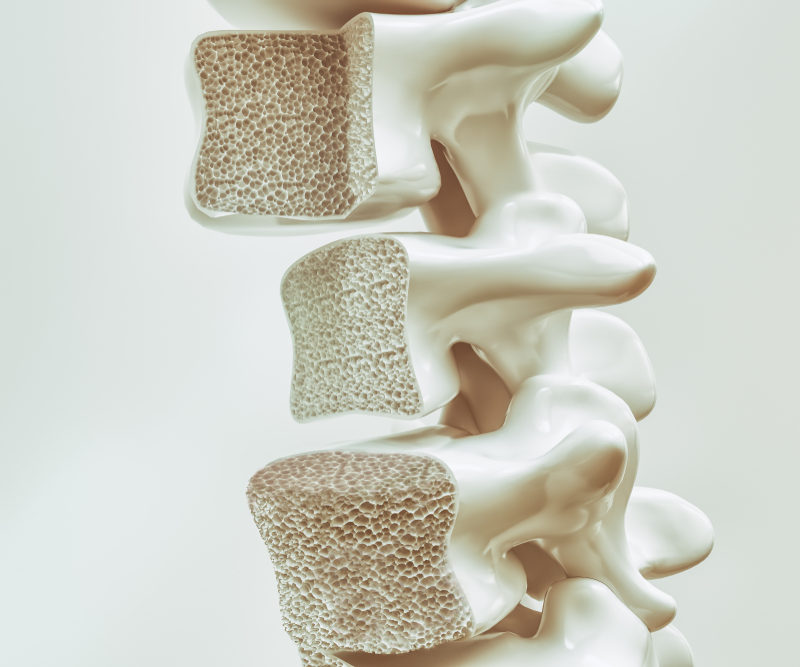VÍDEO: Impactos da osteoporose na saúde da coluna