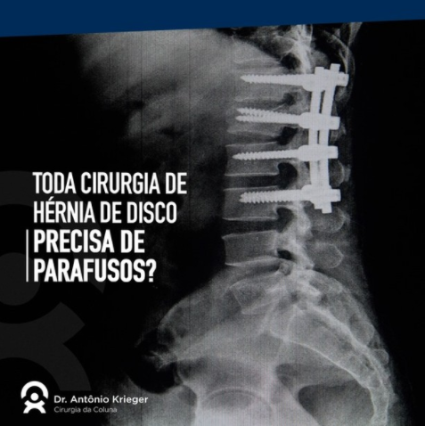 Toda cirurgia de hérnia de disco precisa de parafusos?